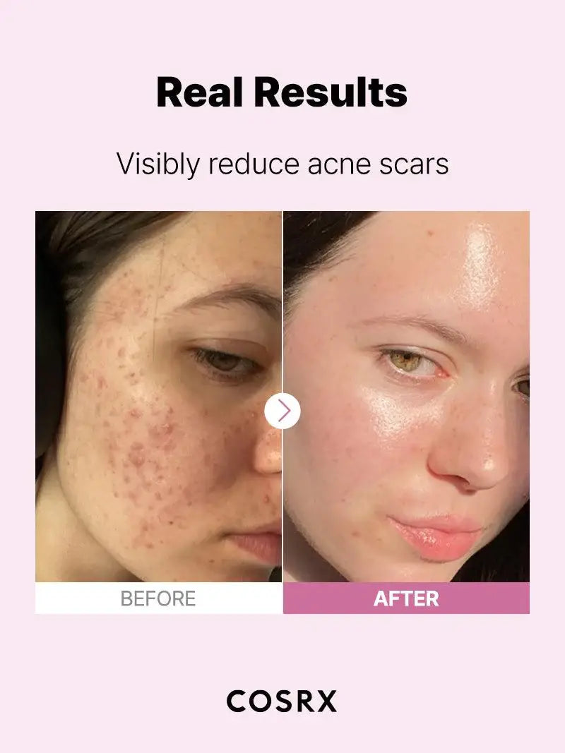 COSRX The Niacinamide 15 Serum Acne